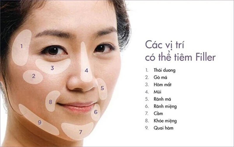 Các vị trí mà bạn có thể thực hiện tiêm Filler