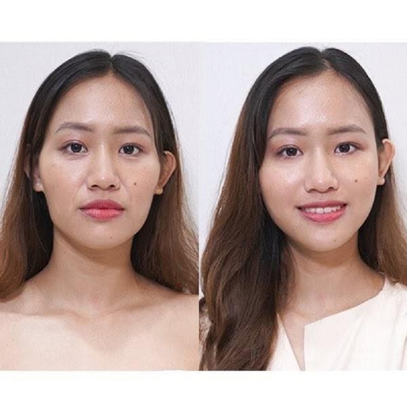 Gương mặt cô gái sau khi làm đầy vùng thái dương đã trở nên cân xứng hơn