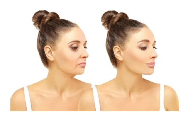 Tiêm Filler không chỉ giúp cân đối thái dương mà còn giúp chống lão hóa