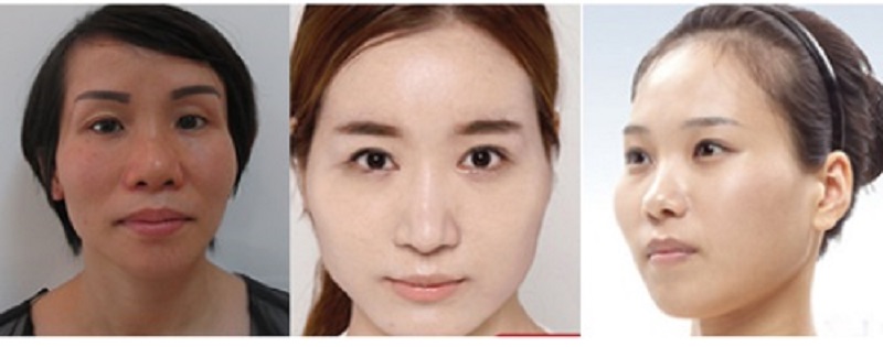 Những phụ nữ vùng thái dương bị hóp, lõm có thể tham khảo dịch vụ tiêm Filler thái dương