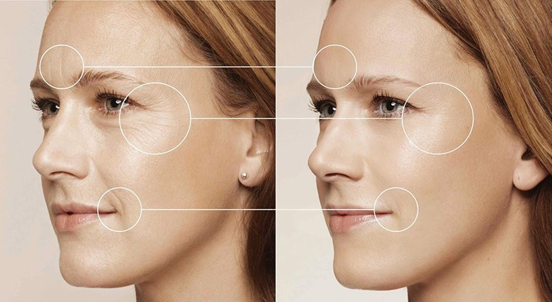 Những việc cần lưu ý nhằm giúp phương pháp trẻ hóa da Laser Carbon tốt nhất
