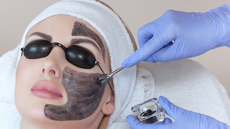 Đắp mặt nạ than hoạt tính trước khi bắn tia laser