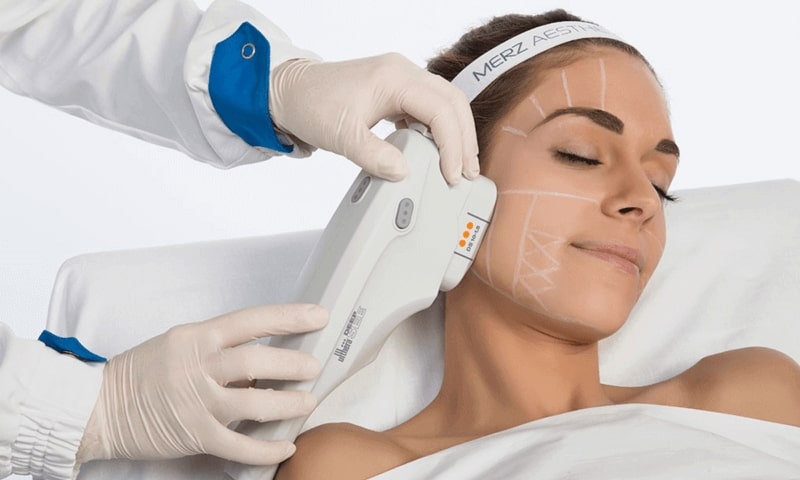 Liệu pháp Ultherapy trẻ hóa làn da tuổi 40