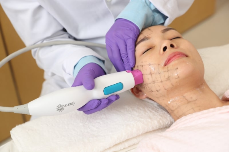 Công nghệ Thermage trẻ hóa da an toàn