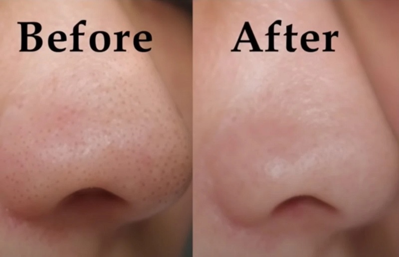 Top 20+ Cách Trị Mụn Đầu Đen Bằng Chanh Top 7 cách trị mụn đầu đen bằng muối và những lưu ý cần biết 48 Trị mụn bằng muối với tần suất thích hợp để da không bị khô