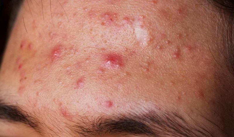 Những đối tượng bị mụn viêm, mụn đầu đen, mụn bọc đều có thể sử dụng dịch vụ này