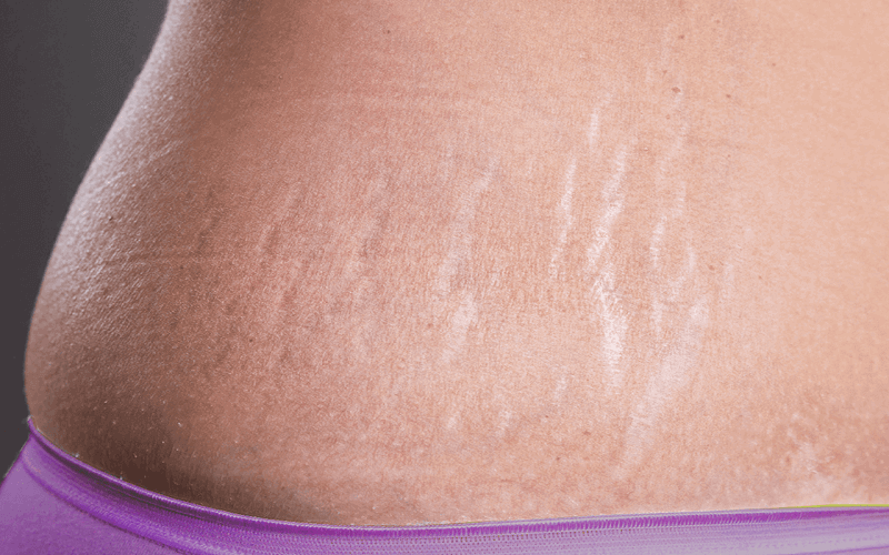 Tia laser có khả năng tăng sinh Collagen và giúp da khỏe mạnh