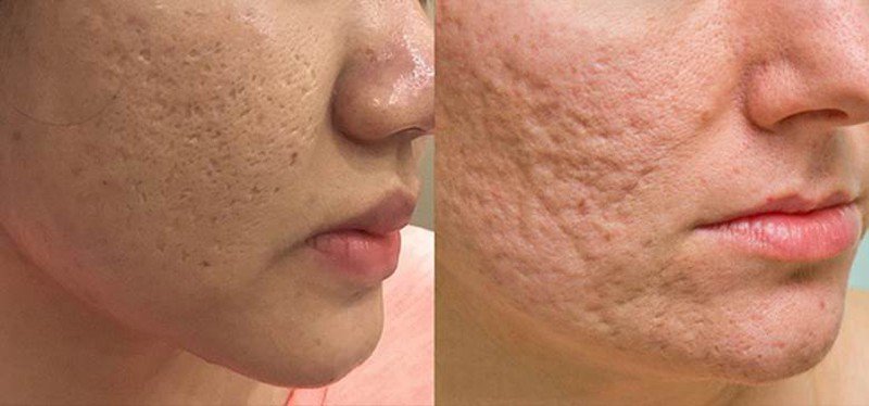 Top 20+ Trị Lỗ Chân Lông To Và Sẹo Rỗ Ở Mặt Sẹo lỗ chân lông to là gì? Top 11++ cách trị hiệu quả 46 Hình dáng sẹo rỗ khiến gương mặt mất thẩm mỹ trầm trọng
