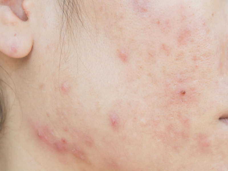 Các lỗ chân lông bị bít tắc sẽ tạo điều kiện cho vi khuẩn gây mụn hoạt động