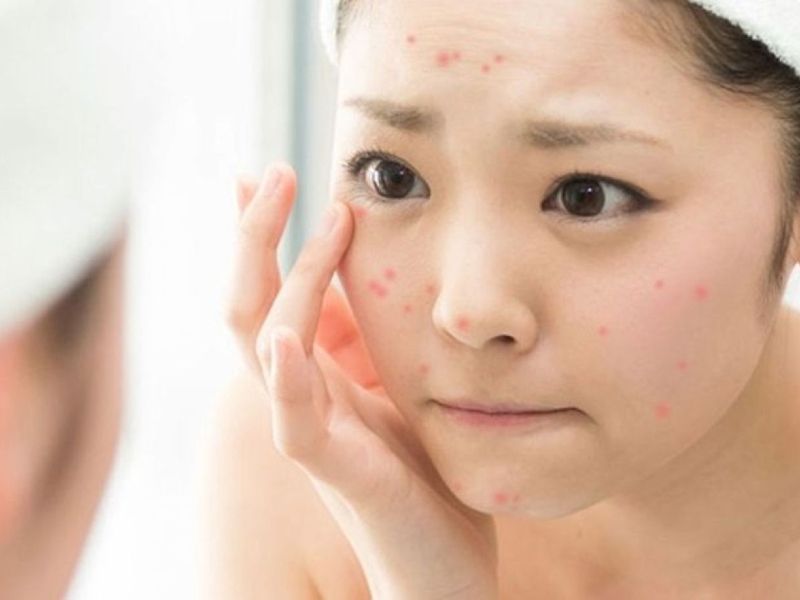 Bạn có thể dễ dàng nhận thấy mụn trứng cá nhờ đặc điểm là các nốt mụn nhỏ như đầu đinh ghim