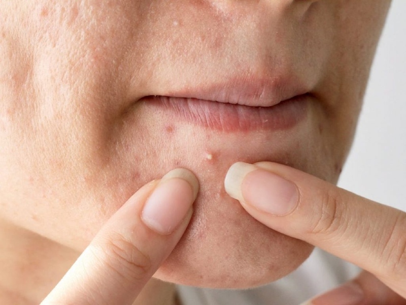 Mụn do nhiễm độc corticoid, hóa chất từ kem trộn