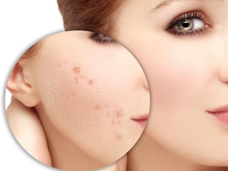 Thâm mụn có thể chữa khỏi hoàn toàn