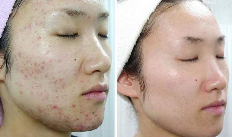 Hiệu quả khách hàng sau khi trị thâm mụn ở Seoul Spa Buôn Ma Thuột