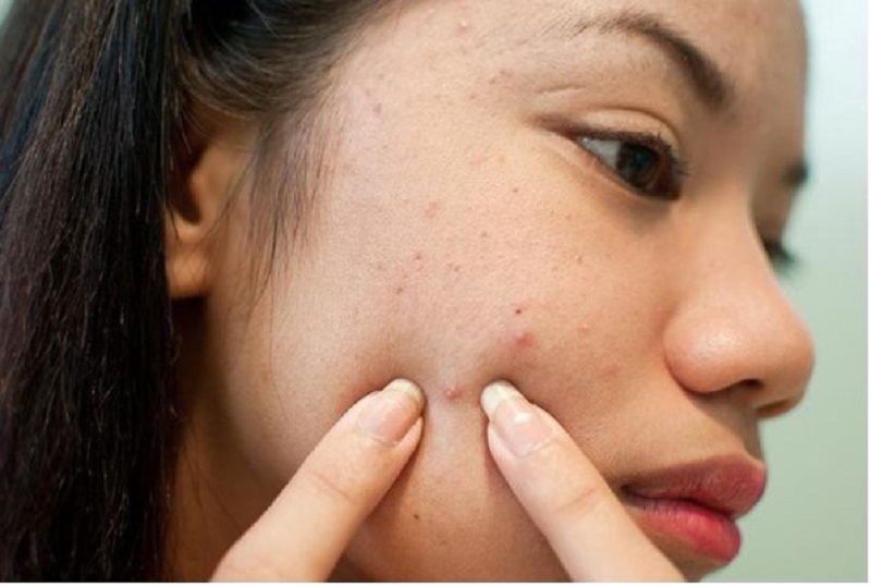 Thâm mụn lâu năm không thể tự hết mà cần có sự can thiệp của công nghệ