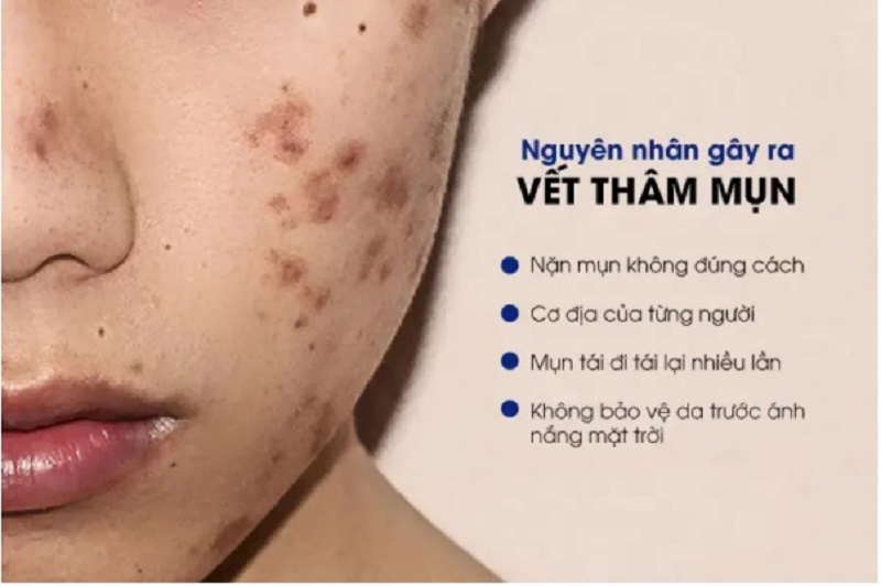 trị thâm mụn ở buôn ma thuột