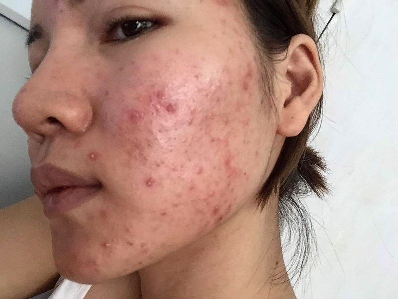 Thâm mụn nỗi ám ảnh của nhiều chị em phụ nữ, vừa gây mất thẩm mỹ gương mặt vừa ảnh hưởng đến tâm lý