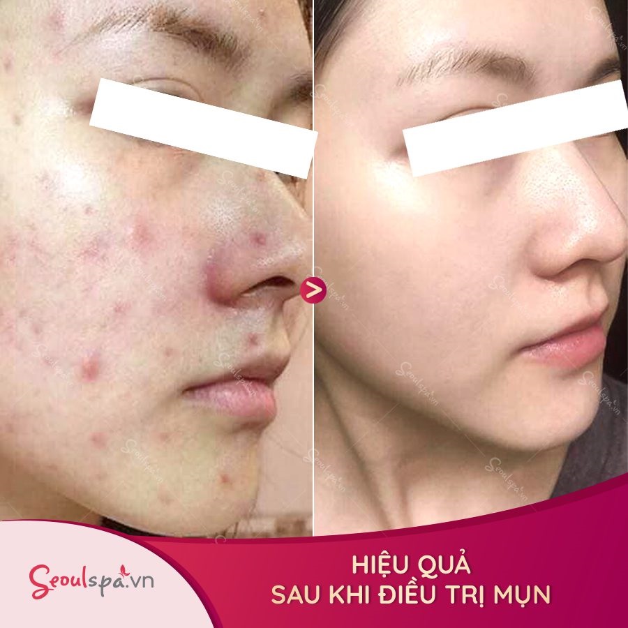 Hiệu quả của khách hàng khi trị thâm mụn tại Seoul Spa