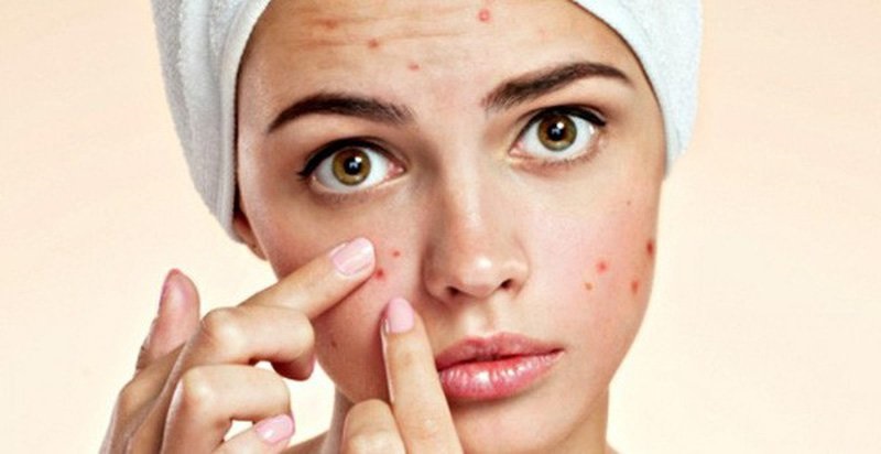 Nặn mụn không đúng cách, không vệ sinh cũng khiến nốt mụn để lại thâm
