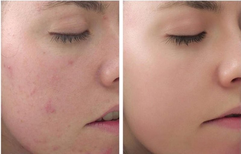 Điều trị thâm mụn tại cơ sở làm đẹp uy tín sẽ mang lại hiệu quả cao và nhanh hơn