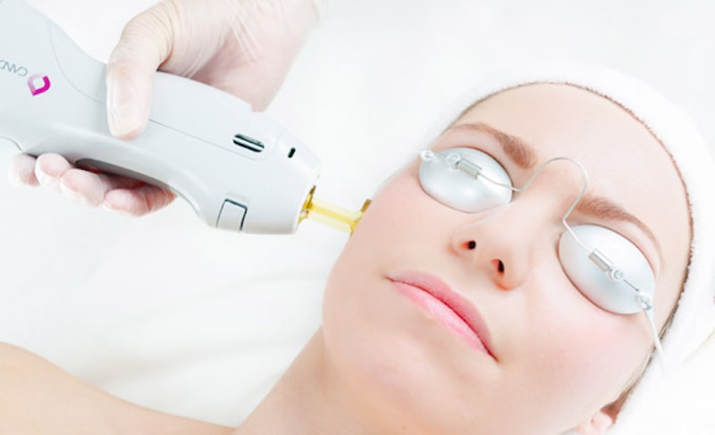 Công nghệ triệt lông vĩnh viễn bằng tia Laser mang lại hiệu quả cao
