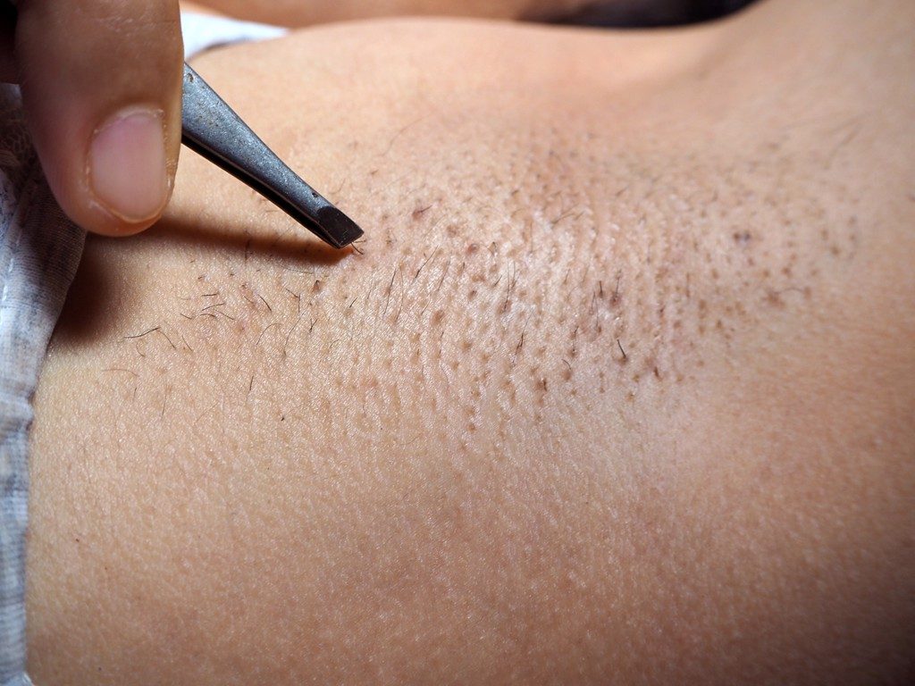 Nhổ bằng nhíp khiến da sần sùi, lỗ chân lông to