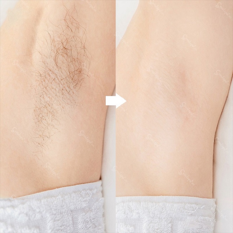 Khách hàng đã triệt lông vĩnh viễn tại Seoul Spa