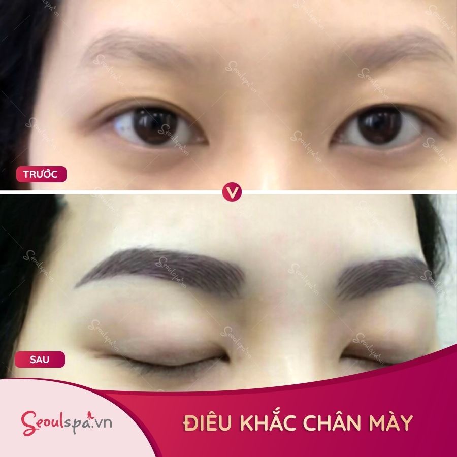 Chân mày mờ nhạt, không rõ dáng, sợi mày thưa thớt đã được khắc phục hoàn toàn sau khi điêu khắc chân mày
