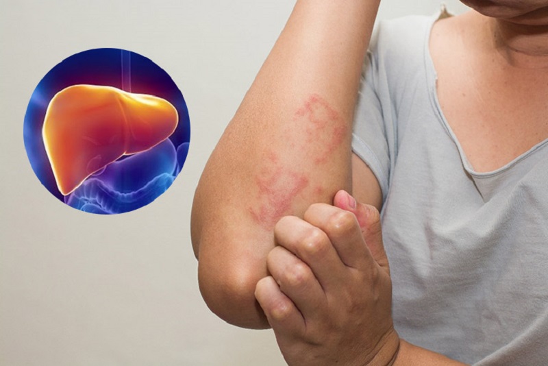Gan tích tụ độc tố cơ thể sẽ có nhiều biểu hiện khác nhau