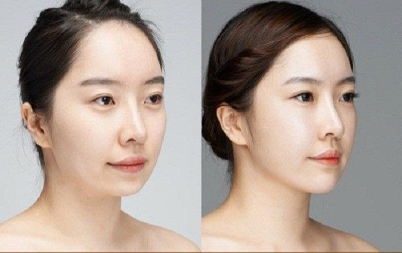 Top 20+ Tiêm Filler Mũi Có Ảnh Hưởng Gì Không Tiêm filler mũi được bao lâu? Có an toàn không? 37 Chăm sóc mũi cẩn thận sau khi tiêm filler mũi