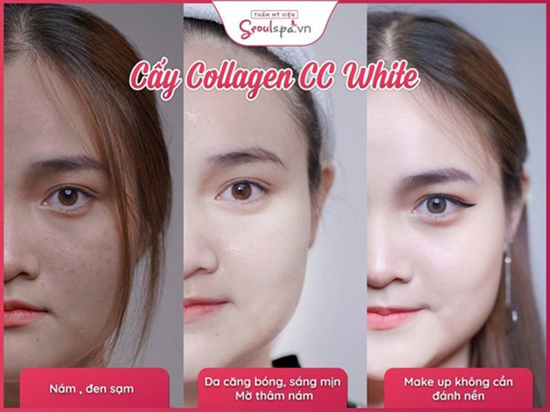 Giúp da trẻ hóa nhờ công nghệ cấy collagen CC White