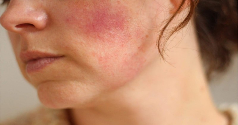 Làn da bạn có thể bị kích ứng nếu vi kim không chính xác