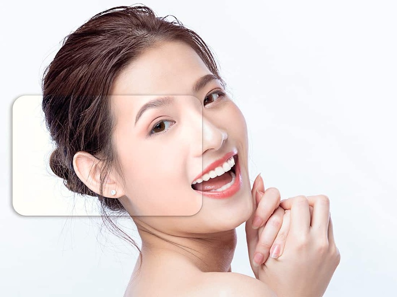 Căng chỉ collagen giúp kéo căng da và trẻ hóa làn da một cách hiệu quả