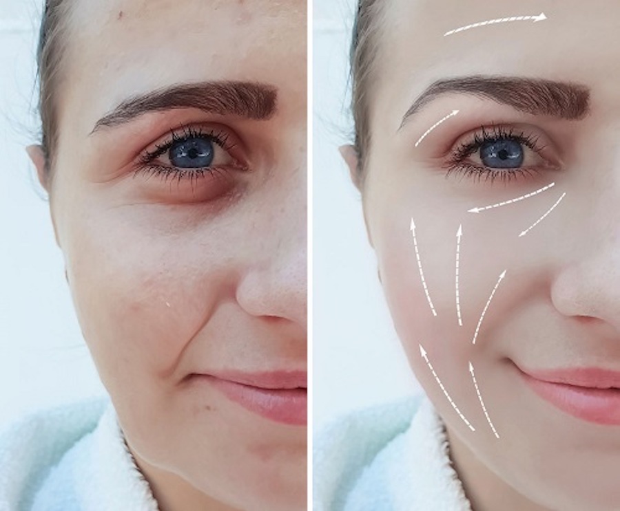 Công nghệ trẻ hóa da Thermage xóa bỏ mọi dấu hiệu chùng nhão, chảy xệ trên mặt bằng bước sóng RF