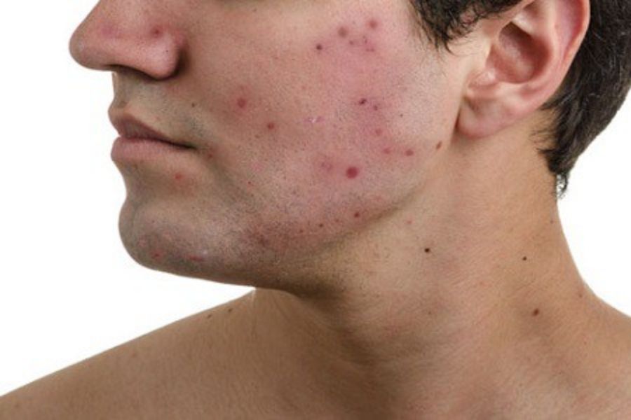 Thực phẩm cay nóng cũng là một trong những nguyên nhân gây mụn