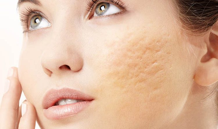 Top 20+ Mặt Bị Rỗ Có Chữa Được Không “Tuyệt chiêu” giúp phục hồi da mặt bị rỗ hiệu quả | SeoulSpa.Vn 52 Tình trạng da mặt bị sẹo rỗ