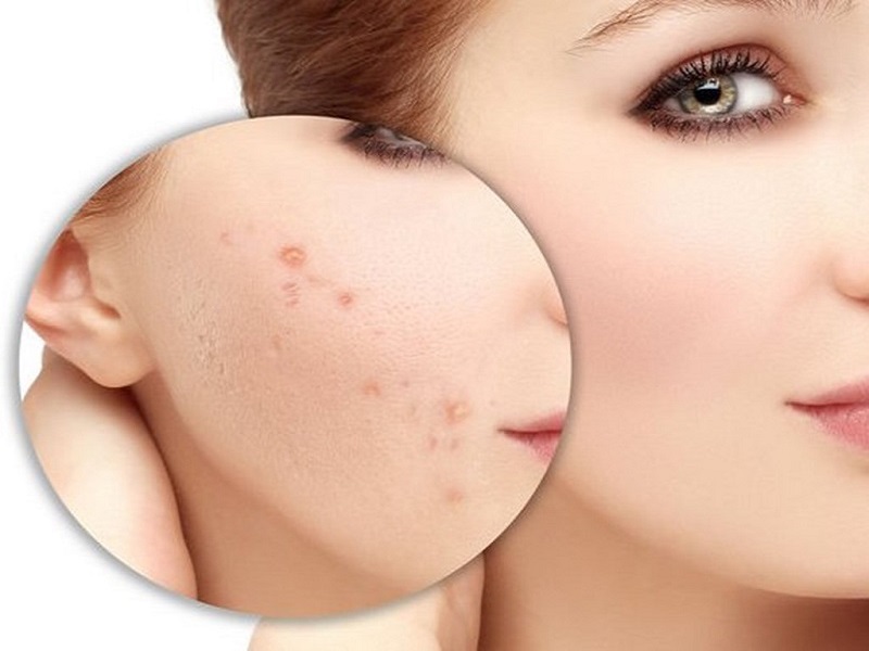 Cần áp dụng đúng cách điều trị thì sẹo mới mờ đi nhanh chóng
