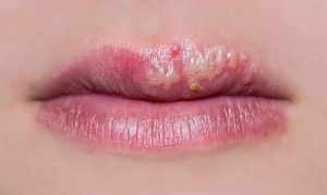 Xăm môi bị mụn nước - Nguyên nhân do đâu và cách xử lý như thế nào? 2 Xăm môi bị nổi mụn nước