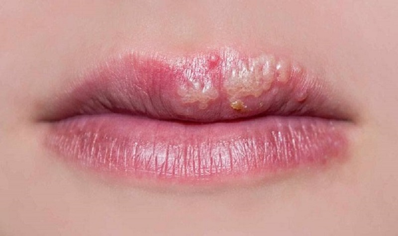 Xăm môi bị mụn nước - Nguyên nhân do đâu và cách xử lý như thế nào? 3 2-Mụn nước sau xăm môi nếu không được xử lý kịp thời có thể dẫn đến nhiều biến chứng nguy hiểm