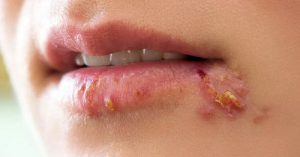 Xăm môi bị mụn nước - Nguyên nhân do đâu và cách xử lý như thế nào? 5 4- Trường hợp bệnh nhân bị mụn nước, mưng mủ tập trung ở môi dưới sau 3 ngày xăm môi, do tay nghề kĩ thuật viên của cơ sở thực hiện còn yếu, đi mực không đều màu