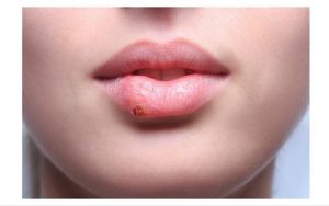 Xăm môi bị mụn nước - Nguyên nhân do đâu và cách xử lý như thế nào? 14 11- Kết quả xăm môi tại emphaidep.com