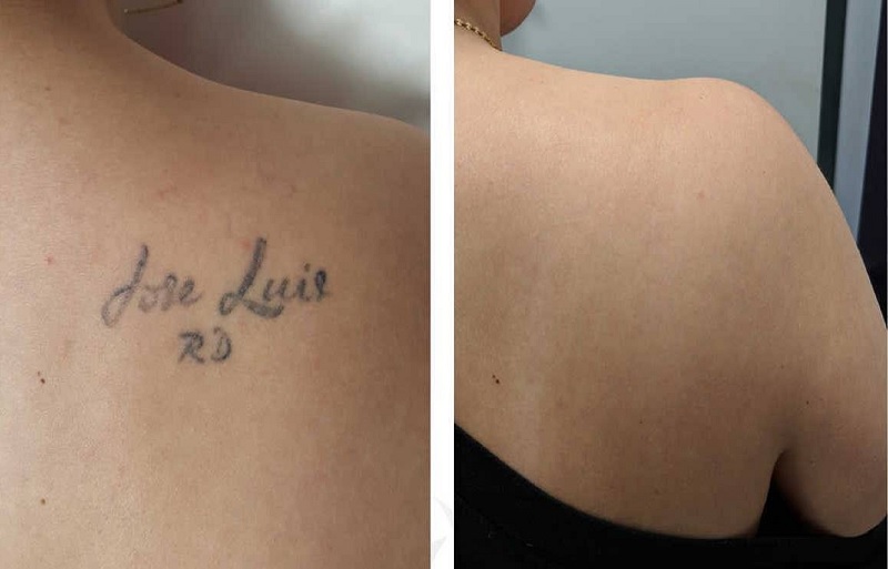 Hiệu quả khi xóa xăm bằng laser