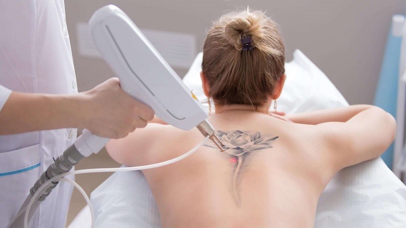 Những hình xăm có kích thước lớn thì mức giá để xóa cũng cao hơn