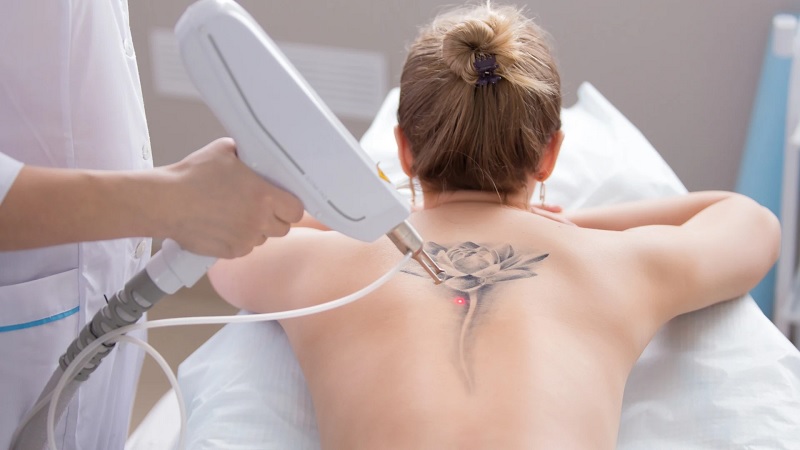 Công nghệ xóa xăm hiện đại đem lại hiệu quả cao