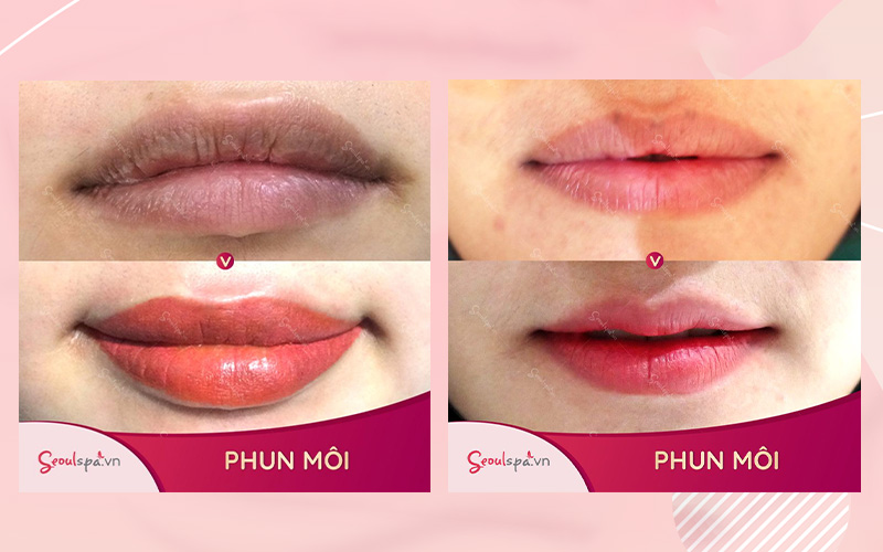 Top 20+ Bánh Bao Ông Cả Cần Quận 10 Hồ Chí Minh Phun môi ăn bánh bao được không? Có được ăn các bánh làm từ bột? 36 Khách hàng trước và sau khi thực hiện phun môi tại Seoul Spa