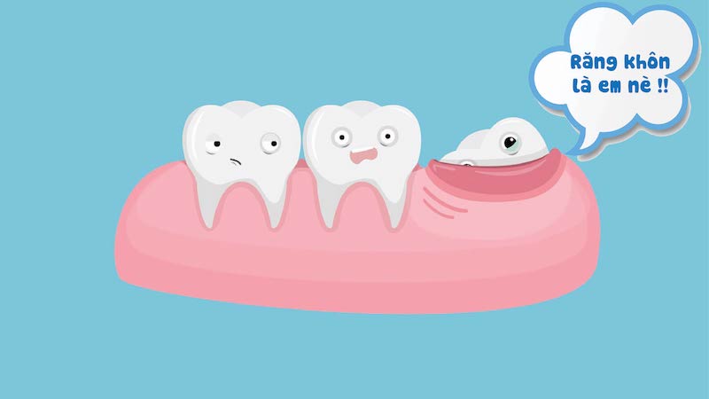 Răng khôn mọc khi nào và khi nào cần nhổ?