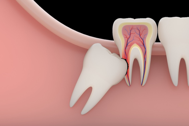Răng khôn mọc có thể gây nứt xương