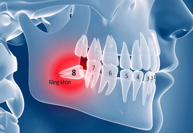 Răng khôn mọc theo hướng nằm ngang