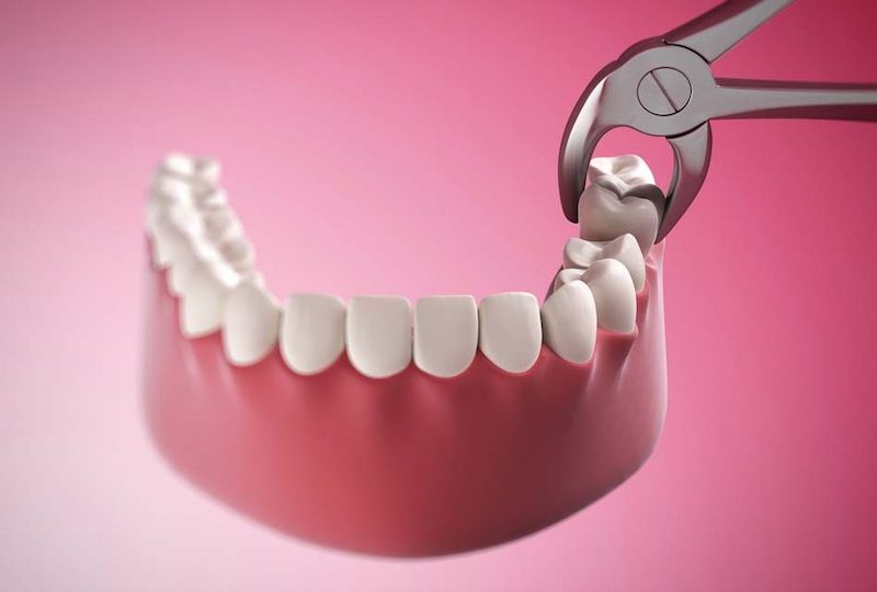 Khi nào cần nhổ răng khôn?
