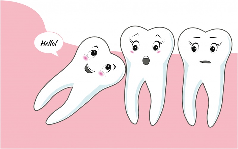 Răng khôn mọc không đúng hướng cần được loại bỏ