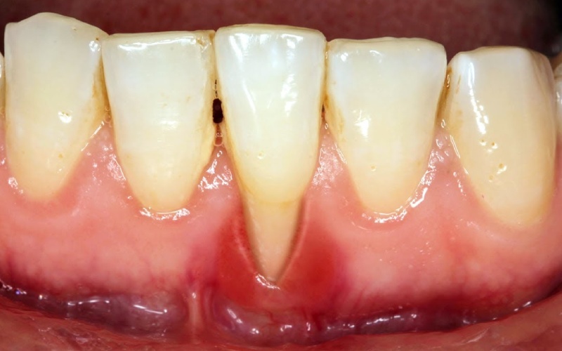 Dấu hiệu nhận biết tuột lợi